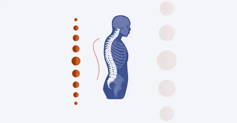 Imagem explicativa: tratamento para cifose