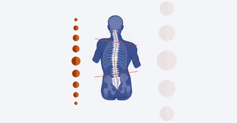 Imagem explicativa: tratamento para escoliose em adultos