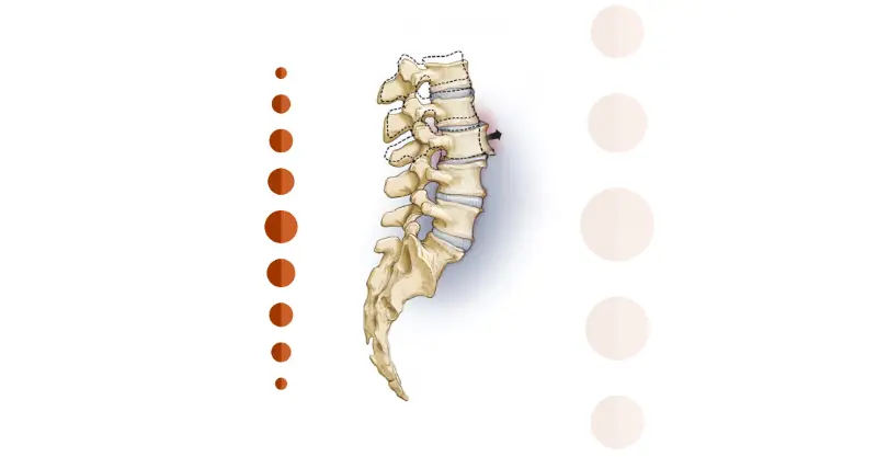 Imagem explicativa: tratamento para espondilolistese
