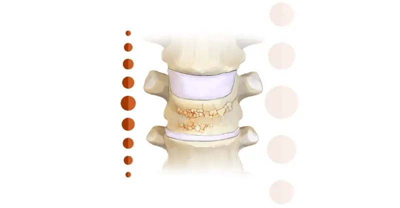 Imagem explicativa: tratamento para fraturas vertebrais